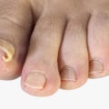 Ram's Horn Toenail Treatment That Brings Instant Relief