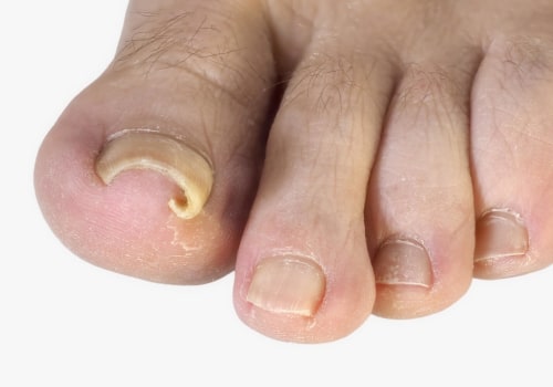 Ram's Horn Toenail Treatment That Brings Instant Relief