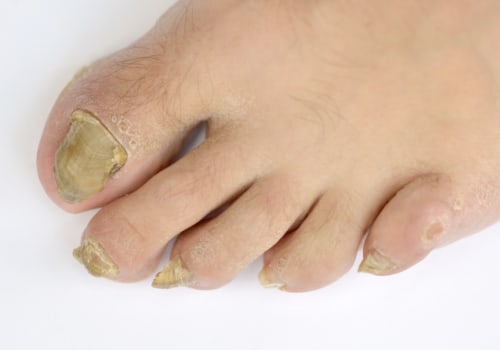 Toenail Fungus Progression Revealed in Stages and Pictures